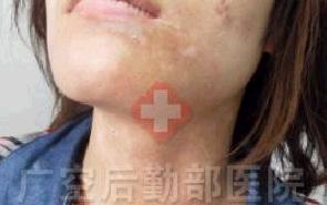 两个月治愈颈部进展期白癜风