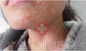 两个月治愈颈部进展期白癜风