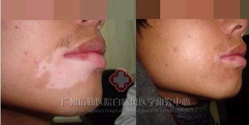 白癜风终于治好了,广州市后勤医院您的“抗白”首选