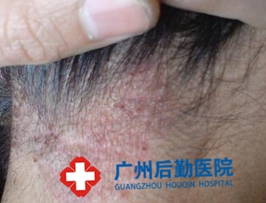 白癜风染发的危害有哪些