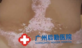 白癜风对患者有哪些危害