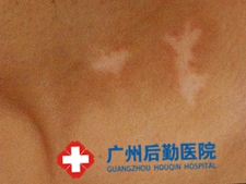 患上白癜风如何诊断