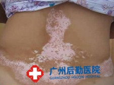 白癜风带来哪些危害