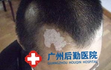 头部白癜风怎样诊断