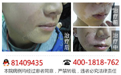 怎样才能及时判断白癜风