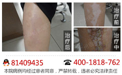 腿部白癜风的特征有哪些