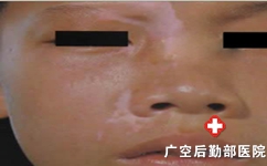 孩子脸上出现的白斑是白癜风吗
