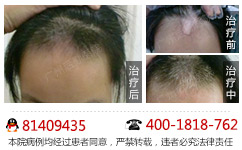 头部白癜风具体的症状有什么