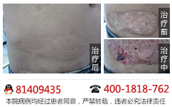 有效鉴别白癜风的手段有哪些