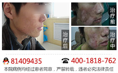 少白头会不会是白癜风的初期病