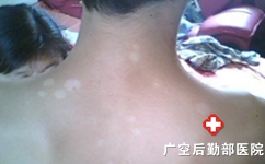 白癜风诊断工作这样进行