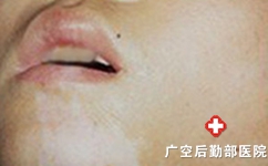 女性白癜风如何进行心理治疗