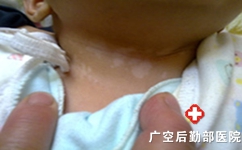 到底如何治疗小儿白癜风