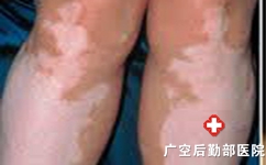 为什么腿上出现一块白色