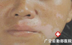 白癜风孕妇治疗要注意什么