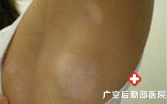 白癜风与硬皮病样扁平苔藓有什么区别