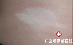 什么原因造成的白癜风可以治疗