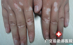 手部白斑的扩散应该怎么控制