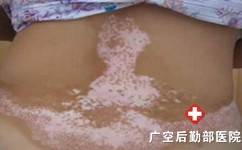 白癜风治疗费用一般需要多少钱