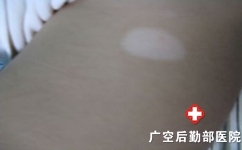白癜风患者一般怎样自我诊断