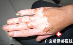 老年患白癜风是什么原因导致的